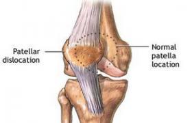 髌骨脱位治疗方法 髌骨脱位 它的治疗方法有哪些