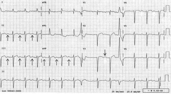 室性期前收缩心电图 心电图挑战|室性期前收缩在心电图中的诊断价值