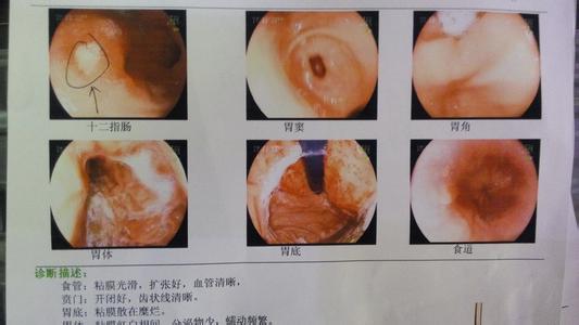 胃溃疡十二指肠溃疡 图文：胃溃疡、十二指肠溃疡、球部溃疡特效秘方