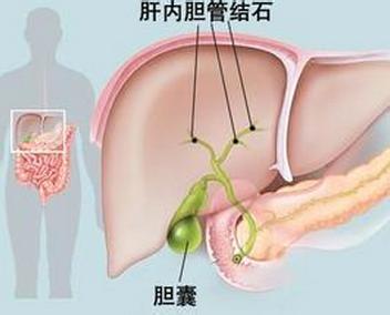 中医治疗结石病 结石怎么治疗 中医治疗结石病的方法