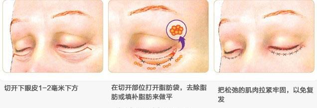 射频除皱去除皱纹最轻 下眼睑除皱 怎么去除下眼睑皱纹？