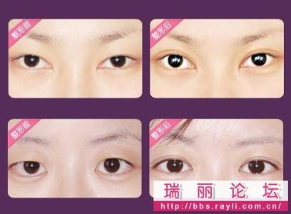 哪家医院双眼皮效果好 最好开双眼皮医院 哪些人做双眼皮效果最好？