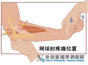 网球肘怎么治疗最好 网球肘是怎么回事 网球肘的症状与治疗