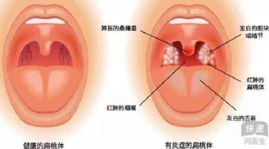 化脓性急性扁桃体炎 孩子化脓性性扁桃体炎怎么护理