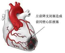 心肌梗塞可以治好吗 心肌梗塞也可以一分钟救治