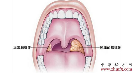 根治化脓性扁桃体秘方 简单有效的治疗扁桃体秘方