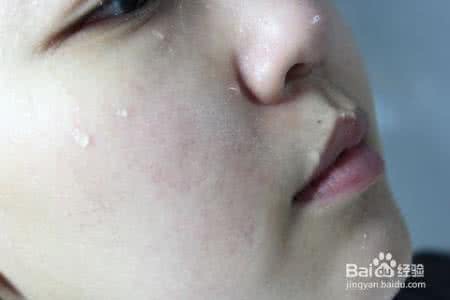 胸前背后长痘痘原因 胸前背后长痘痘原因 背后长痘痘原因?