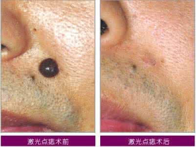 脸部黑痣图 69%的人是脸部黑痣的“被粉丝” 去痣有讲究