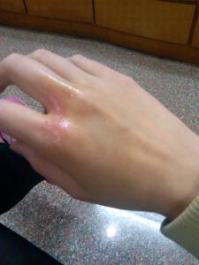 开水烫伤起泡要挑破吗 烫伤起泡要挑破吗？为什么？