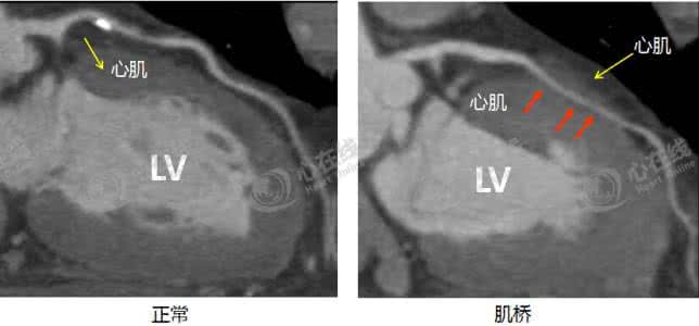 冠脉心肌桥 【微课堂】冠脉CTA：心肌桥的识别