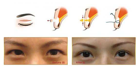 肿眼睛双眼皮埋线法 肿眼睛双眼皮埋线法 双眼皮埋线法和切开法有什么样的区别？