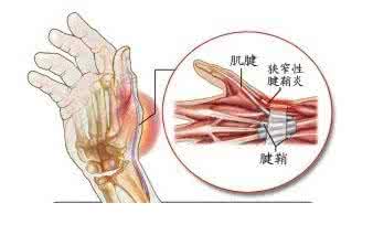 腱鞘炎的治疗方法偏方 腱鞘炎如何治疗？