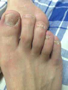 冰醋酸治疗灰指甲 冰醋酸可以治疗灰指甲吗?灰指甲最佳治疗方法