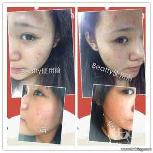 荷柏园祛痘霜事件 荷柏园祛痘霜事件 祛痘最怕的五件事，你知道吗？