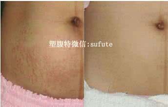 去妊辰纹什么牌子好 去妊辰纹 如何去妊娠纹,去妊娠纹哪个牌子好