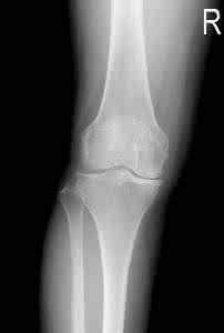 退变性关节炎 退变性关节炎怎么治 退变性关节病的诊断相关