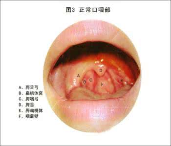 治慢性咽炎最佳方法 慢性咽炎。