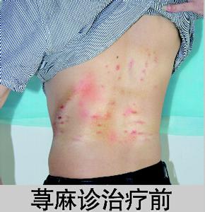 中医治疗荨麻疹的方法 荨麻疹的中医治疗方法有哪些 荨麻疹的治疗