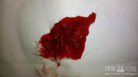 痔疮治疗方案 又一痔疮出血案
