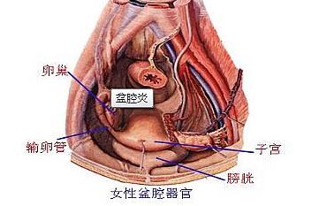 根治慢性盆腔炎的偏方 慢性盆腔炎的相关知识