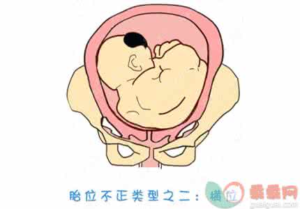 胎位不正有哪些症状 胎位不正的症状