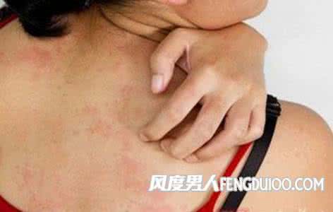 皮肤瘙痒症怎么治 皮肤瘙痒症 为什么会有皮肤瘙痒症