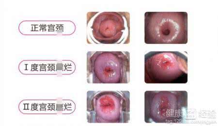 轻度宫颈糜烂什么症状 轻度宫颈糜烂的症状 什么是轻度宫颈糜烂