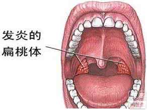 扁桃体炎和咽炎的鉴别 慢性咽炎和扁桃体炎有什么区别