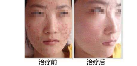 面部痤疮粉刺如何去 封闭性粉刺 面部痤疮的治疗