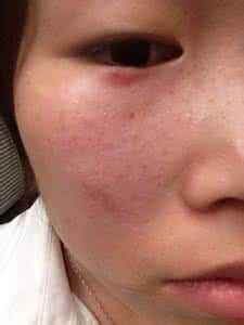 孕妇嘴角长疱疹怎么办 孕妇嘴角长疱疹 孕妇嘴角长疱疹了怎么办