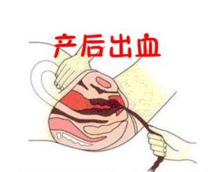 产后出血的原因 怎样减轻产后出血的影响