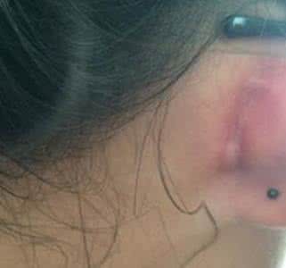 巴氏腺囊肿术后护理 巴氏腺囊肿 巴氏腺囊肿的预防与护理