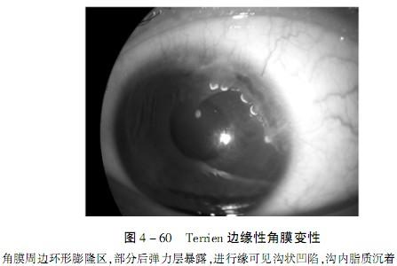 角膜边缘变性 角膜变性 得了Terrien角膜边缘性变性该怎么办,Terrien角膜边缘性变性最有效的治疗方法