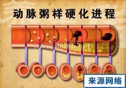 动脉粥样硬化斑块 专家谈动脉粥样硬化斑块