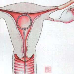宫内节育器避孕原理 宫内节育器避孕原理 避孕之宫内节育器法