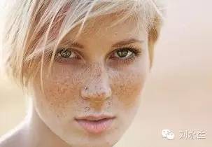 雀斑的形成原因及预防 雀斑是怎么形成的?注意预防雀斑的方法