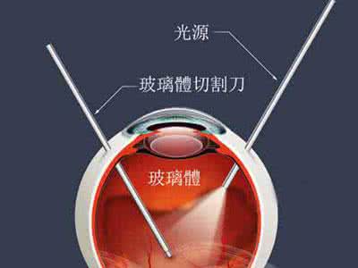 丙烷气体报警器 丙烷气体报警器 关注眼用全氟丙烷气体严重不良反应事件