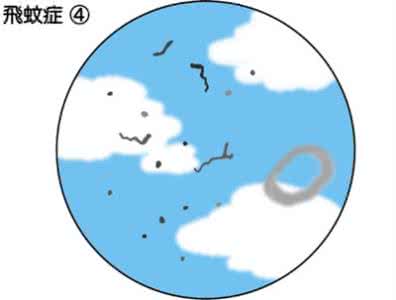 飞蚊症是怎么回事 飞蚊症是怎么回事 得了飞蚊症怎么办