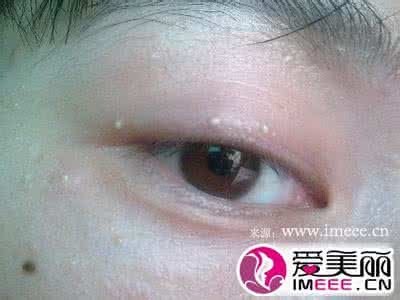 眼袋脂肪粒怎么消除 消除脂肪粒 4步消除消除脂肪粒 让你眼周零瑕疵