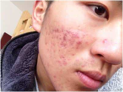 严重痤疮一般多久能好 痤疮是怎么引起的