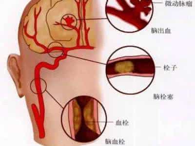 脑血栓嘴歪艾灸哪里 警惕这些脑血栓的征兆, 怎么用艾灸预防脑血栓?