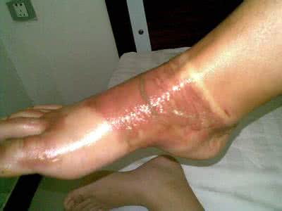 开水烫伤怎么处理 开水烫伤怎么处理 三种烫伤程度的处理方法