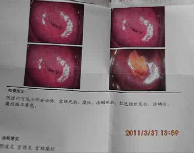 宫颈糜烂可以怀孕吗 宫颈糜烂可以怀孕吗 宫颈糜烂伴有“它”，怀孕要暂缓了