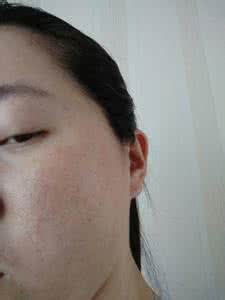 颈部皮肤过敏怎么办 春季皮肤过敏怎么办 皮肤过敏有什么食疗