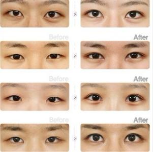 眼部整形手术 眼部整形手术 眼部整形手术选择指南