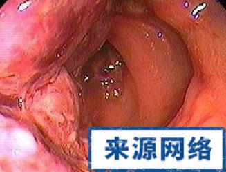 克罗恩会便血么 克罗恩会便血么 克罗恩便血吗?
