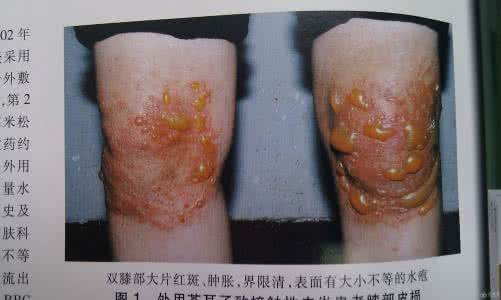 素颜霜妃龄七白膏 皮肤病  古方“七白膏”新用