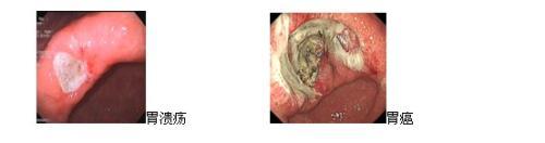 胃癌与胃溃疡的鉴别表 胃癌与为胃溃疡的鉴别