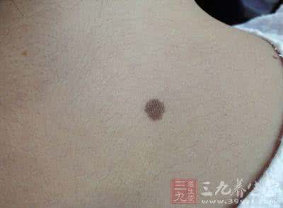 福痣剃破发现癌变 福痣剃破发现癌变 从身体上的痣看出疾病