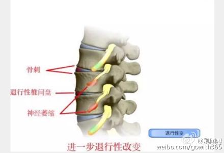 腰椎退化 腰椎退化 【前沿医讯】吃咖喱有助延迟脑退化